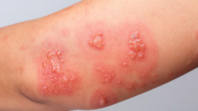 5 Natural Remedies for Poison Ivy Rashes